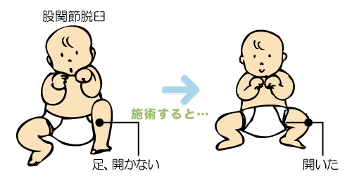股関節の脱臼と回排制限